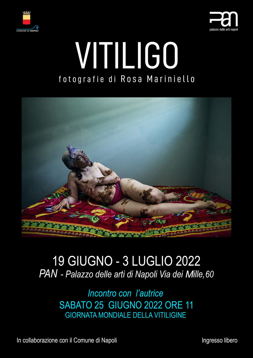 locandina mostra Vitiligo